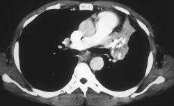 Left Upper Lung Collapse Due to Tuberculosis (TB) - CTisus CT Scan