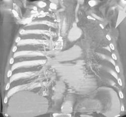Lung Cancer With Left Upper Lung Collapse - CTisus CT Scan