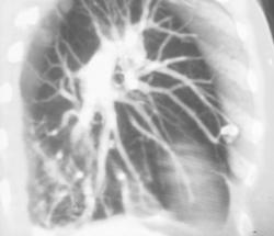 Calcified Granuloma Lung Simulates An Arteriovenous Malformation (AVM) - CTisus CT Scan