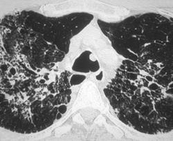 Polyp in Airway. Not Lung Fibrosis - CTisus CT Scan