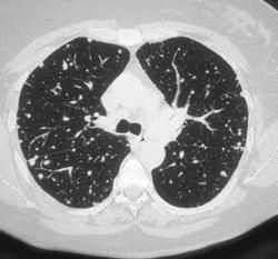 Thyroid Metastases to the Lung - CTisus CT Scan