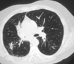 Lung Cancer With Lymphangitic Spread - CTisus CT Scan