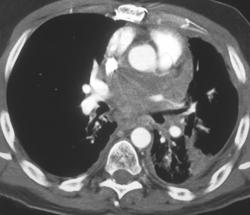 Small Cell Lung Cancer Infiltrates Heart and Mediastinum - CTisus CT Scan
