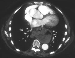 Multiple Pulmonary Emboli as Well as Hiatal Hernia - CTisus CT Scan