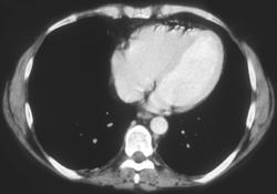 Air in the Pericardium - CTisus CT Scan
