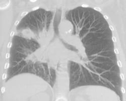 Lung Cancer Encases the Right Mainstem Bronchus - CTisus CT Scan