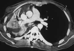 Collapsed Lung Due to Mucus Plug in Post Operative Patient - CTisus CT Scan