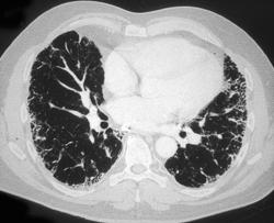 Idiopathic Pulmonary Fibrosis (IPF) - CTisus CT Scan