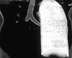 3D of Collapsed Lung Due to Mucus Plug - CTisus CT Scan