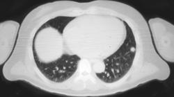Lung Metastases With A Negative PET Scan - CTisus CT Scan