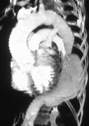 Focal Aneurysm Descending Aorta - CTisus CT Scan
