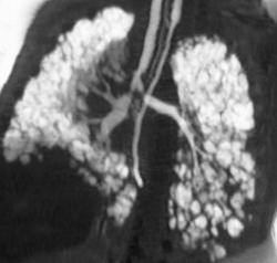 Post Peep Lungs in Child With Emphysema - CTisus CT Scan