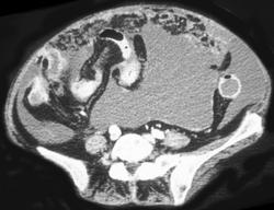 Carcinomatosis and Malignant Effusion Due to Ovarian Cancer - CTisus CT Scan
