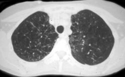 Emphysema - CTisus CT Scan