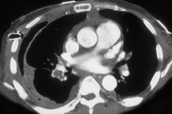 Pulmonary Embolism - CTisus CT Scan