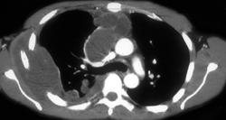Loculated Effusion - CTisus CT Scan