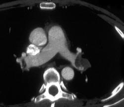 Pulmonary Embolism - CTisus CT Scan