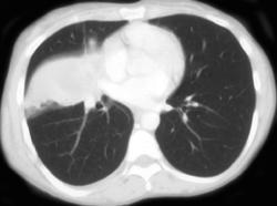 Abscess With Loculated Fluid - CTisus CT Scan