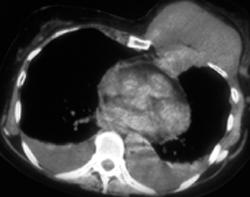 Chest Wall Sarcoma - CTisus CT Scan