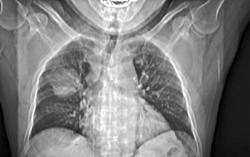 Pleural Lipoma Simulates A Right Upper Lung Mass - CTisus CT Scan