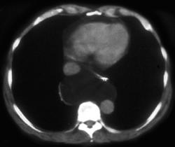 Hernia of Mesenteric Fat - CTisus CT Scan