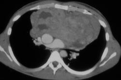 Lymphoma - CTisus CT Scan