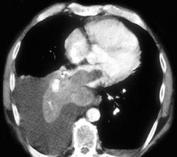Lung Cancer Invades the Left Atrium - CTisus CT Scan