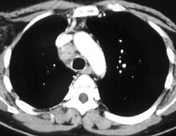 Lung Cancer With Adenopathy - CTisus CT Scan