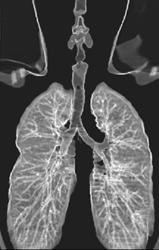 3D Lung - CTisus CT Scan