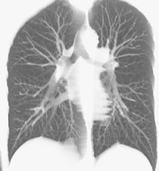 3 Mm Cavity Nodule in Left Upper Lung - CTisus CT Scan