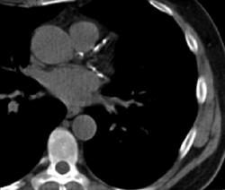 Coronary (LAD, Circumflex) Calcification - CTisus CT Scan