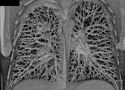 Right Upper Lobe Mass - CTisus CT Scan
