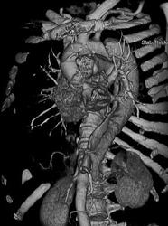 Aortic Dissection - CTisus CT Scan
