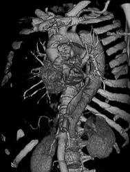 Type B Dissection - CTisus CT Scan