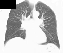 Normal 3D VRT and MIP of the Lung - CTisus CT Scan