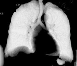 Normal 3D of the Lung - CTisus CT Scan