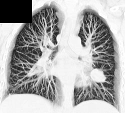 Left Lower Lung Mass - CTisus CT Scan