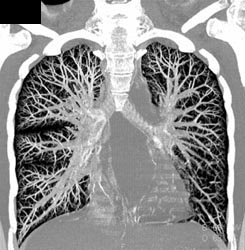 Normal Lung - CTisus CT Scan