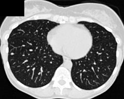 3 Mm Right Lower Lung Nodule - CTisus CT Scan
