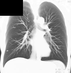 3 Mm Right Lung Nodule - CTisus CT Scan