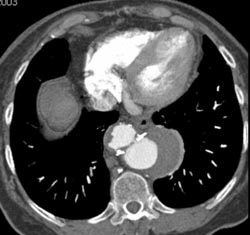 Ulcer in Thoracic Aorta - CTisus CT Scan
