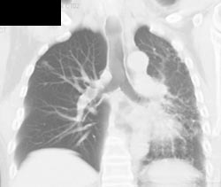Bronchiectasis - CTisus CT Scan