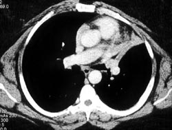 Carcinoid in Left Upper Lung - CTisus CT Scan