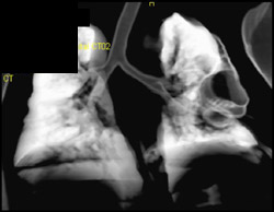 Cystic Structure Lung C/w Cystic Adenomatoid Malformation - CTisus CT Scan