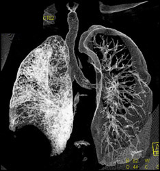 Diseased Native Lung Plus Lung Transplant - CTisus CT Scan