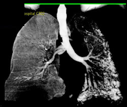 End Stage Lung Disease With Single Lung Transplant - CTisus CT Scan