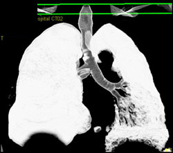 Virtual Bronchoscopy - CTisus CT Scan