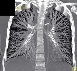 MIP of Lungs - CTisus CT Scan