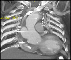 Focal Dissection in Aortic Root - CTisus CT Scan