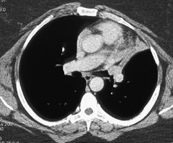 Collapsed Left Upper Lung Due to Airway Tumor - CTisus CT Scan